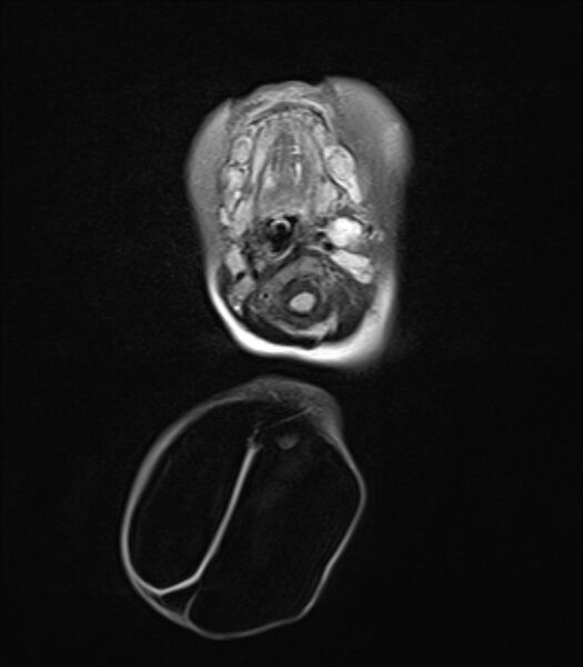 File:Chiari III malformation with occipital encephalocele (Radiopaedia 79446-92559 Axial FLAIR 7).jpg
