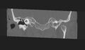 Cholesteatoma (Radiopaedia 10742-11203 Coronal bone window 6).jpg