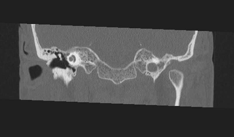 File:Cholesteatoma (Radiopaedia 10742-11203 Coronal bone window 6).jpg