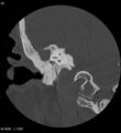 Cholesteatoma (Radiopaedia 5467-7197 Coronal bone window 20).jpg