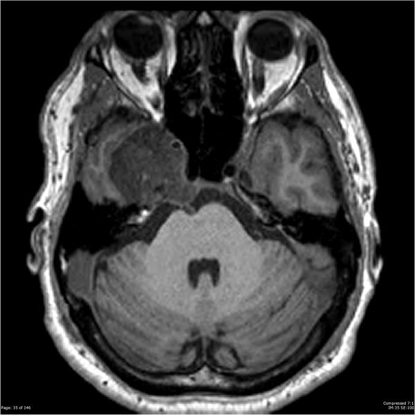 File:Chondrosarcoma of skull base- grade II (Radiopaedia 40948-43654 Axial T1 35).jpg