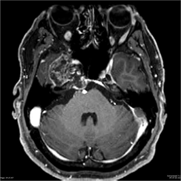 File:Chondrosarcoma of skull base- grade II (Radiopaedia 40948-43654 Axial T1 C+ 22).jpg