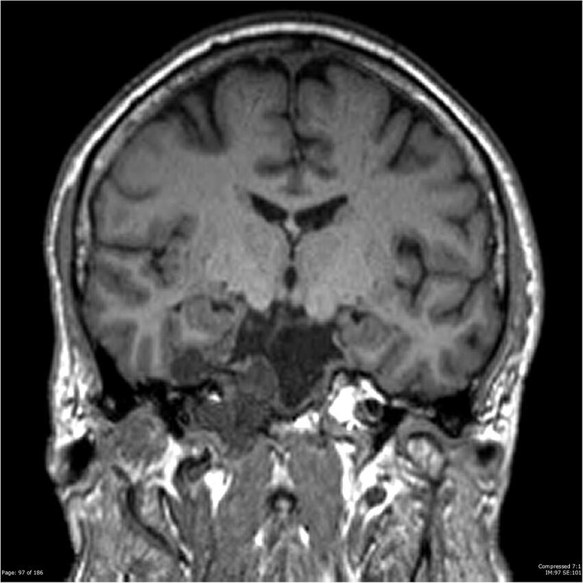 Chondrosarcoma of skull base- grade II (Radiopaedia 40948-43654 Coronal T1 18).jpg
