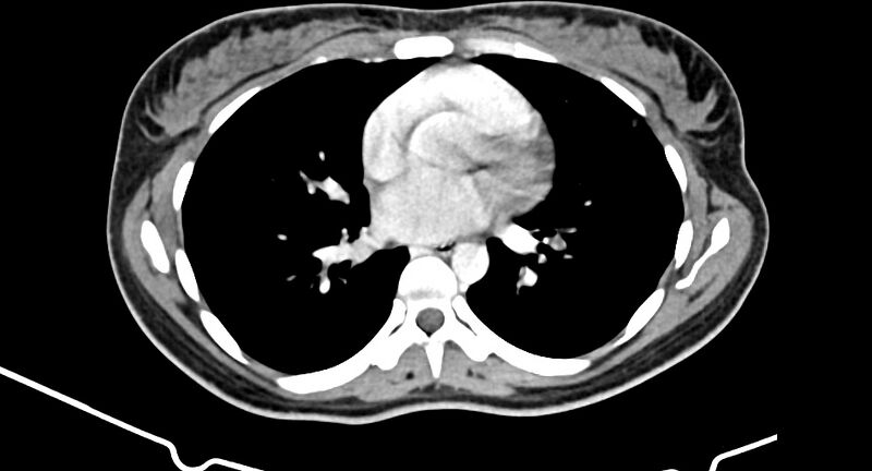 File:Choriocarcinoma liver metastases (Radiopaedia 74768-85766 A 2).jpg