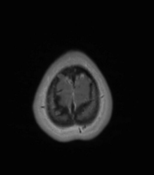 File:Choroid plexus carcinoma (Radiopaedia 91013-108553 Axial T1 C+ 200).jpg
