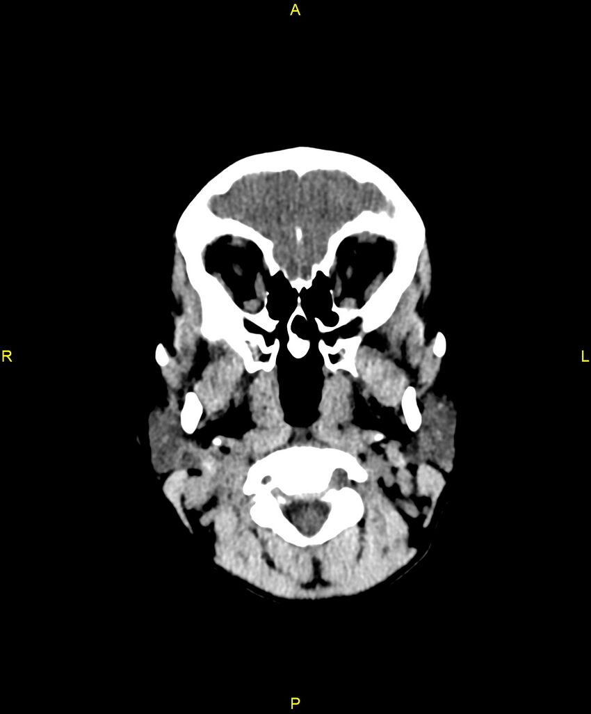 Choroidal fissure cyst (Radiopaedia 89481-106465 Axial non-contrast 15).jpg