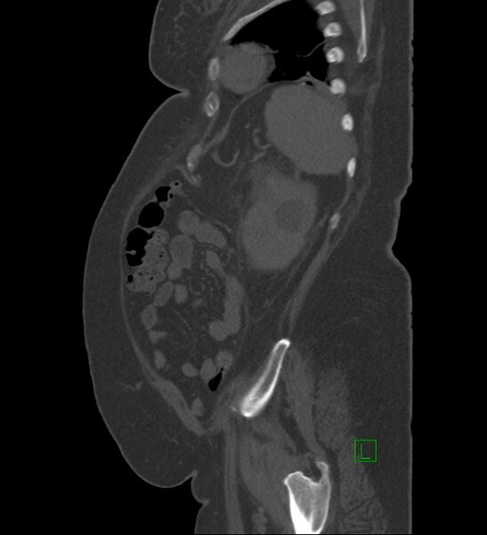 File:Chromophobe renal cell carcinoma (Radiopaedia 84239-99519 Sagittal bone window 19).jpg