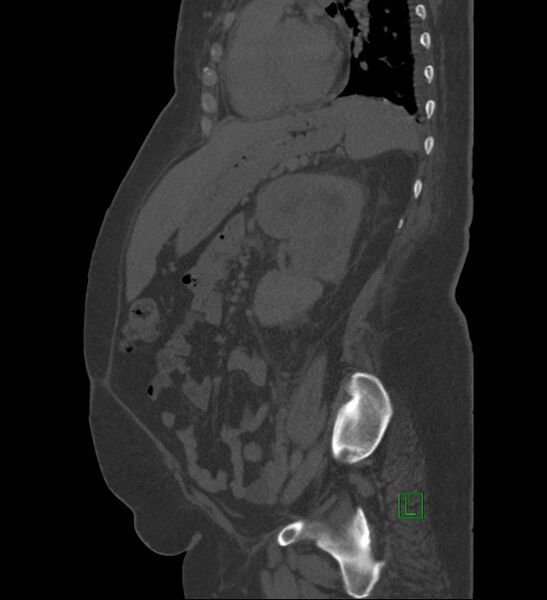 File:Chromophobe renal cell carcinoma (Radiopaedia 84239-99519 Sagittal bone window 37).jpg