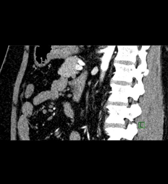 File:Chromophobe renal cell carcinoma (Radiopaedia 84286-99573 F 73).jpg