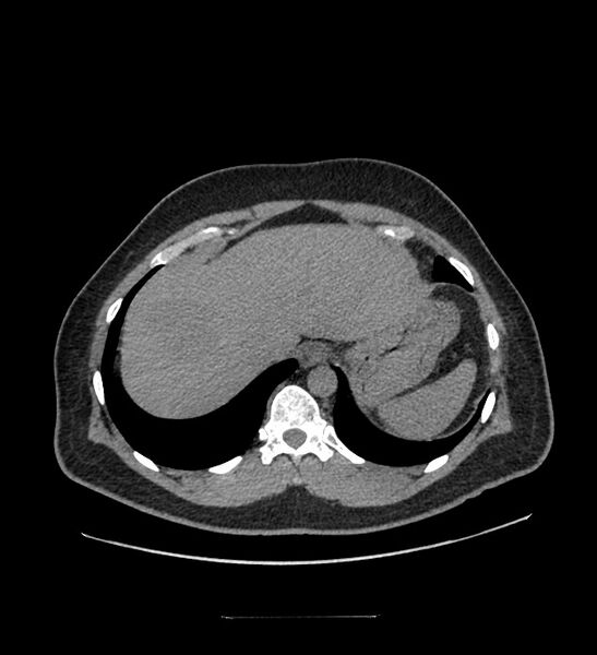 File:Chromophobe renal cell carcinoma (Radiopaedia 84337-99644 Axial non-contrast 12).jpg