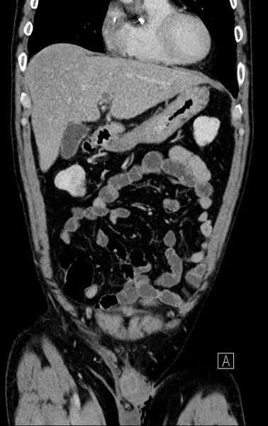 File:Chronic appendicitis complicated by appendicular abscess, pylephlebitis and liver abscess (Radiopaedia 54483-60700 C 24).jpg