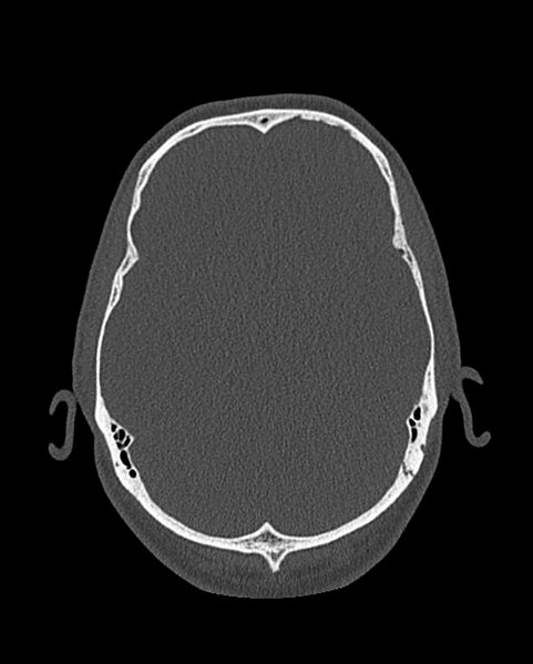 File:Chronic maxillary sinusitis caused by a foreign body (Radiopaedia 58521-65676 Axial bone window 314).jpg