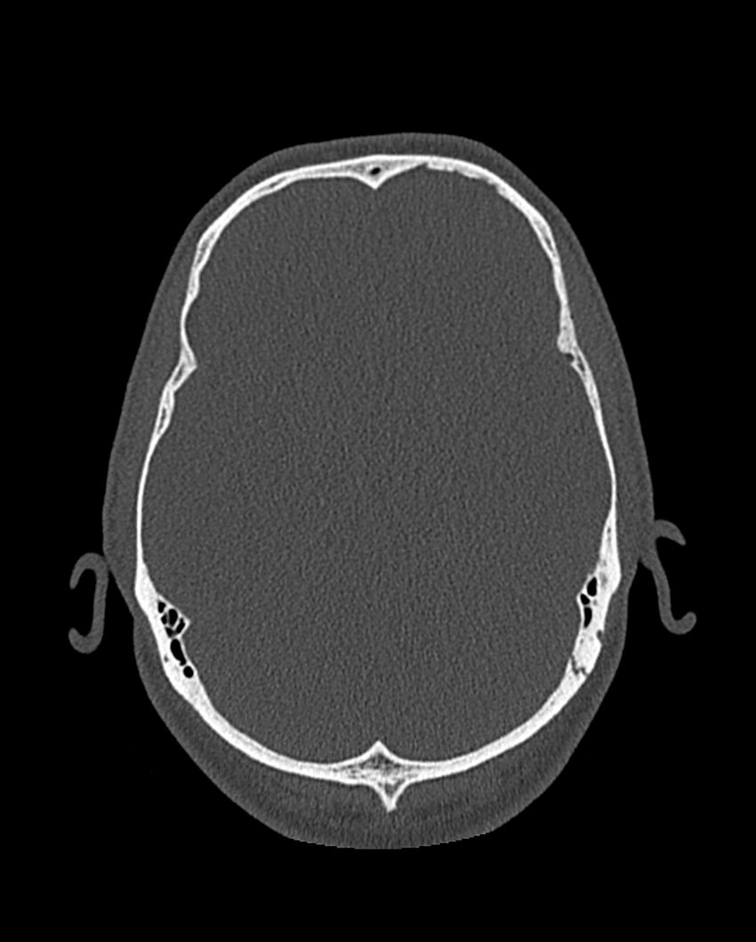 Chronic maxillary sinusitis caused by a foreign body (Radiopaedia 58521-65676 Axial bone window 314).jpg