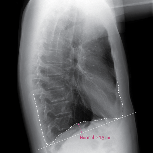 File:Chronic obstructive pulmonary disease - marked hyperinflation (Radiopaedia 8512-15224 A 1).png