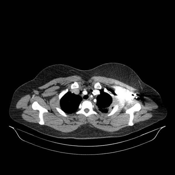 File:Chronic thromboembolic pulmonary hypertension (CTEPH) (Radiopaedia 74597-85532 Axial C+ CTPA 137).jpg