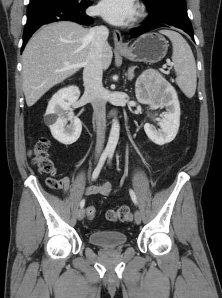 File:Clear cell renal cell carcinoma (Radiopaedia 61449-69393 F 18).jpg