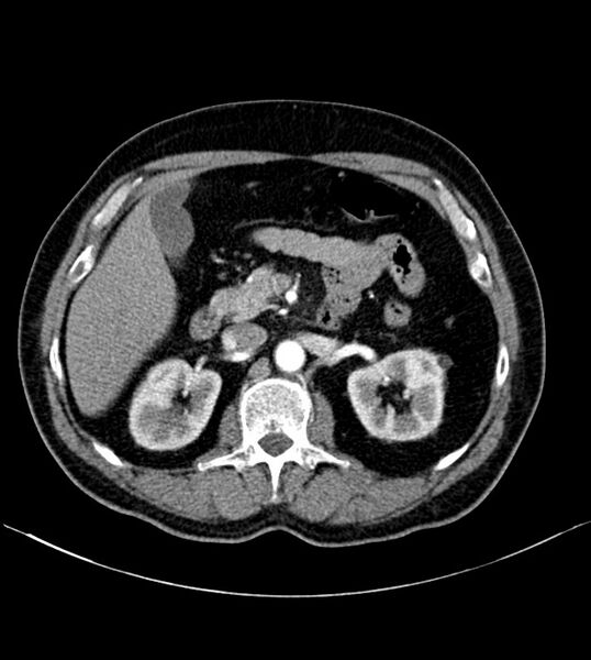 File:Clear cell renal cell carcinoma (Radiopaedia 85006-100539 B 34).jpg