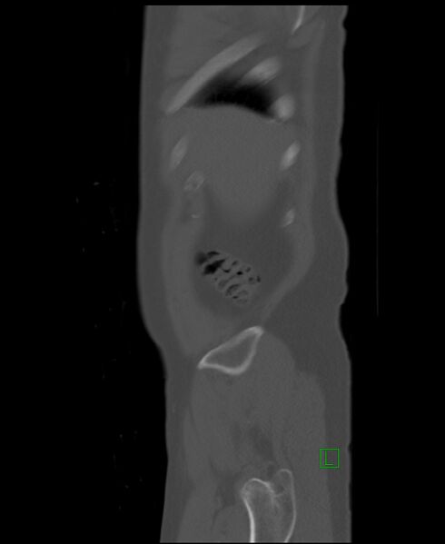 File:Clear cell renal cell carcinoma (Radiopaedia 85006-100539 Sagittal bone window 56).jpg