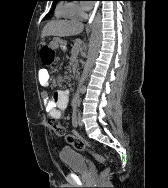 File:Closed-loop small bowel obstruction-internal hernia (Radiopaedia 78439-91096 C 74).jpg