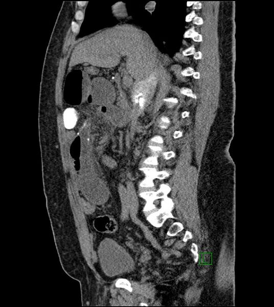 File:Closed-loop small bowel obstruction-internal hernia (Radiopaedia 78439-91096 C 85).jpg