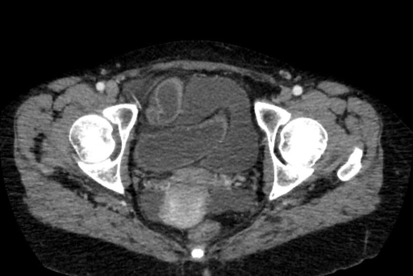 Closed loop small bowel obstruction (Radiopaedia 71211-81508 A 161).jpg