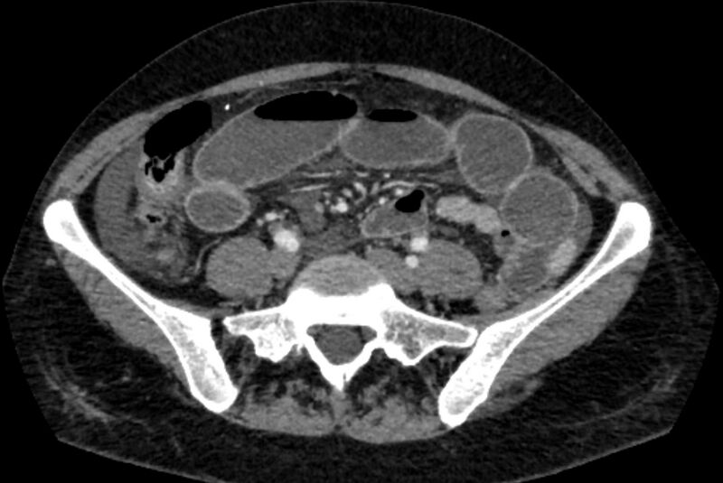 File:Closed loop small bowel obstruction (Radiopaedia 71211-81508 A 95).jpg