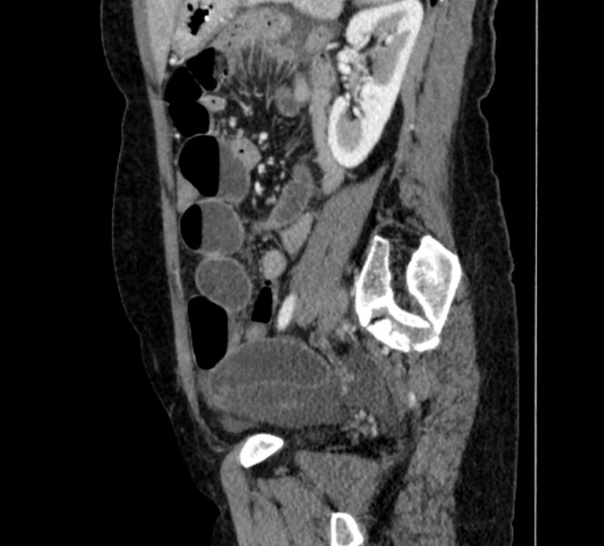 File:Closed loop small bowel obstruction (Radiopaedia 71211-81508 C 111).jpg