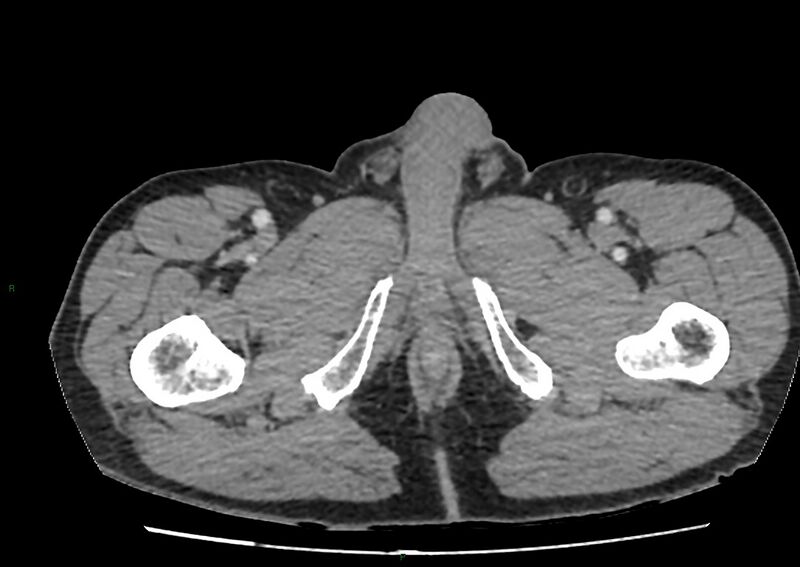 File:Closed loop small bowel obstruction with ischemia (Radiopaedia 84180-99456 A 133).jpg
