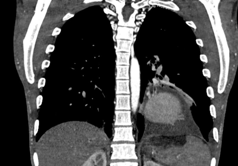 File:Coarctation of aorta with aortic valve stenosis (Radiopaedia 70463-80574 C 174).jpg