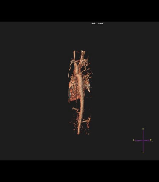File:Coarctation of the aorta (Radiopaedia 43373-46729 3D reconstruction 10).jpg