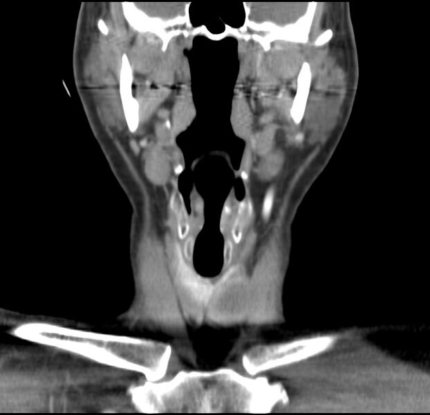 File:Colloid cyst of thyroid (Radiopaedia 22897-22923 Coronal C+ delayed 25).jpg