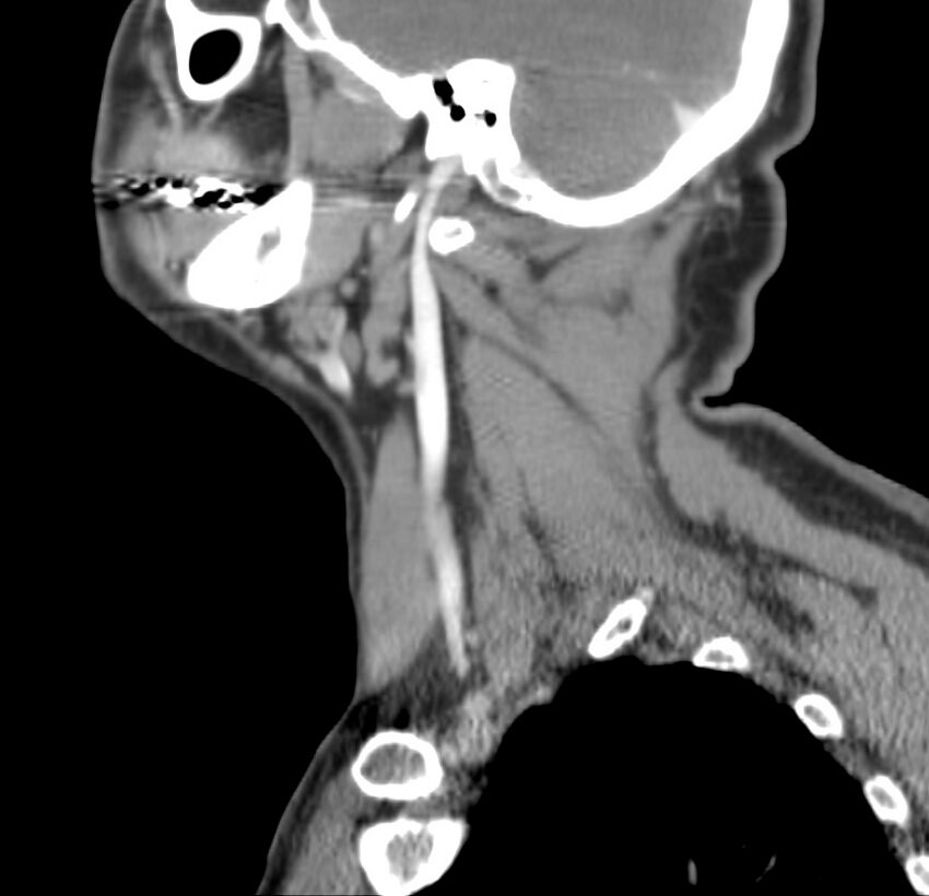 Colloid cyst of thyroid (Radiopaedia 22897-22923 Sagittal C+ delayed 43).jpg