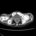 Colocolic fistula - Crohn disease (Radiopaedia 57063-63955 A 92).jpg