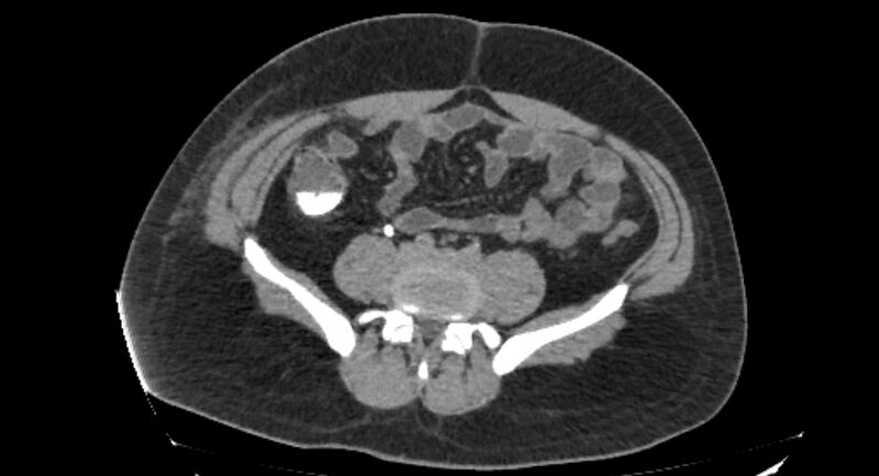 File:Colocutaneous fistula (Radiopaedia 56401-63062 Axial Fistulography 24).jpg