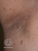 Freckling in the armpit (DermNet NZ systemic-nf3).jpg