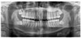 Impacted wisdom teeth (OPG) (Radiopaedia 87939).JPG