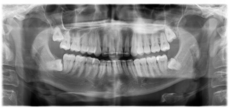 File:Impacted wisdom teeth (OPG) (Radiopaedia 87939).JPG
