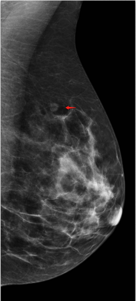 File:Intramammary lymph node - left breast (Radiopaedia 21305).png