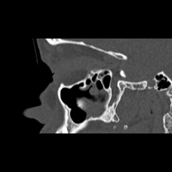 File:Nasal septal perforation (Radiopaedia 25030-25289 Sagittal bone window 6).jpg