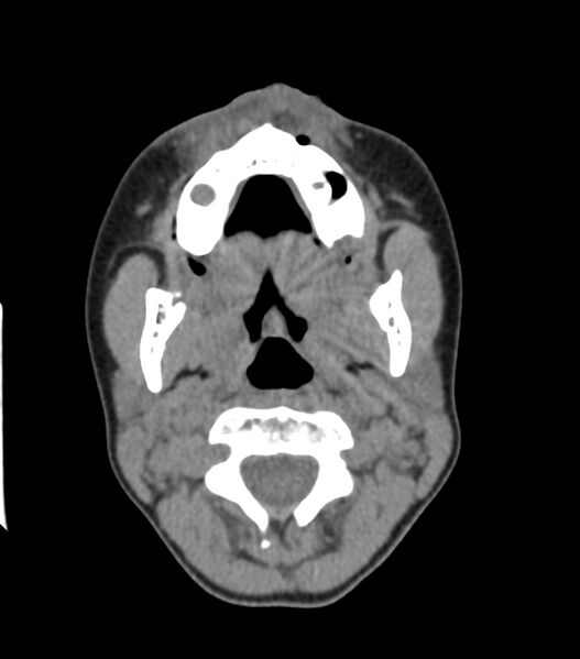 File:Nasoorbitoethmoid fracture (Radiopaedia 90044-107205 Axial non-contrast 91).jpg