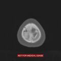 Nasopharyngeal carcinoma recurrence - skull base destruction (Radiopaedia 29107-29490 Axial bone window 6).jpg