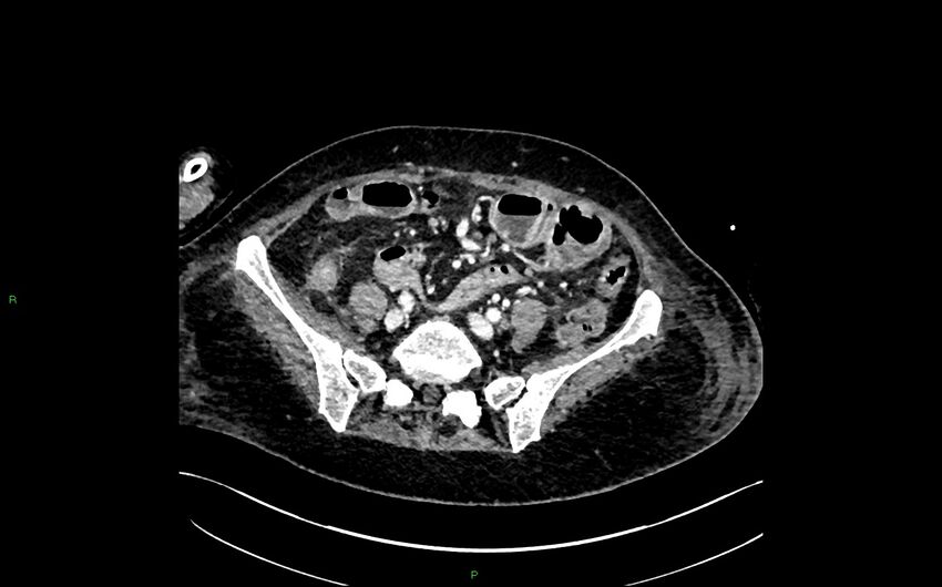 Neo-terminal ileal stricture (Crohn disease) (Radiopaedia 33790-34948 A 325).jpg