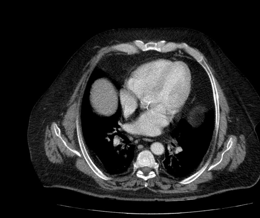 Nephroptosis with inguinal hernia containing perirenal fat (Radiopaedia 56632-63391 C 19).jpg
