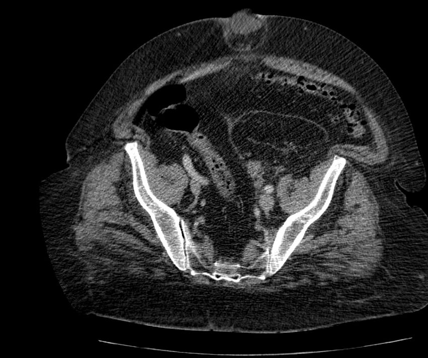 Nephroptosis with inguinal hernia containing perirenal fat (Radiopaedia 56632-63391 C 276).jpg