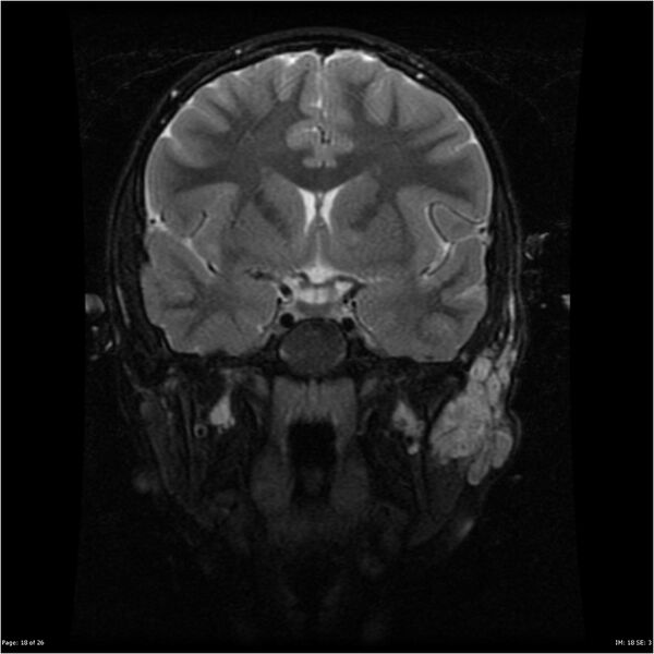 File:Neurofibromatosis type 1 (Radiopaedia 22541-22564 C 18).jpg