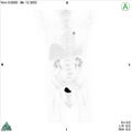 Non-Hodgkin lymphoma involving seminal vesicles with development of interstitial pneumonitis during Rituximab therapy (Radiopaedia 32703-33752 PET cor 3D MIP 1).jpg