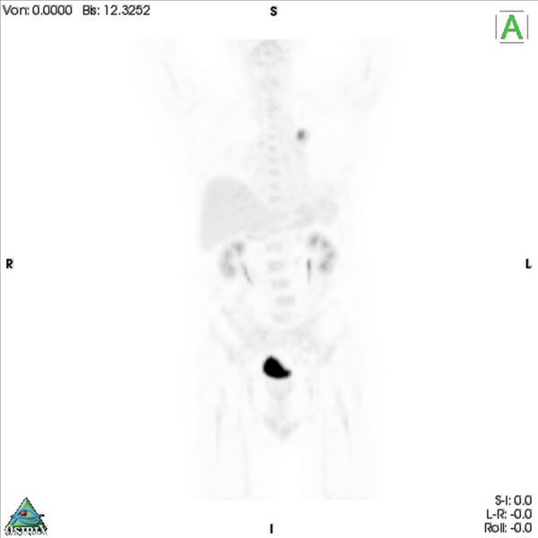 File:Non-Hodgkin lymphoma involving seminal vesicles with development of interstitial pneumonitis during Rituximab therapy (Radiopaedia 32703-33752 PET cor 3D MIP 1).jpg