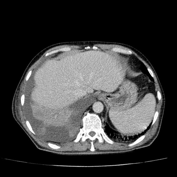 File:Non small-cell lung cancer (Radiopaedia 24467-24769 C+ delayed 53).jpg
