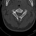 Normal CT of the cervical spine (Radiopaedia 53322-59305 Axial bone window 90).jpg