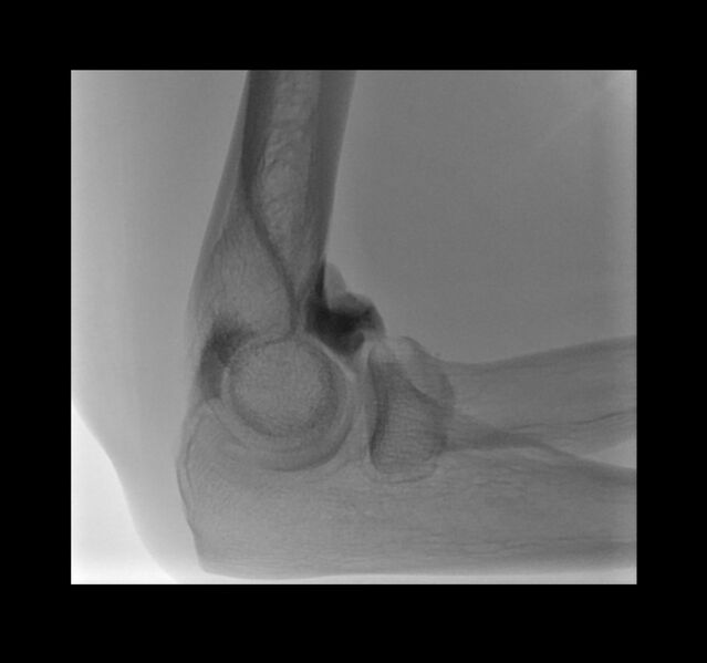 File:Normal elbow arthrograms (Radiopaedia 75550-86830 C 1).jpg